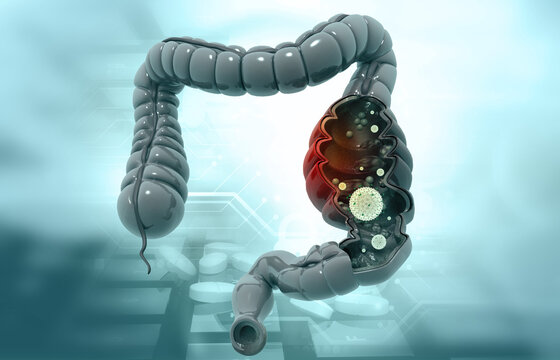 Diseased human colon cross section anatomy. 3d illustration.