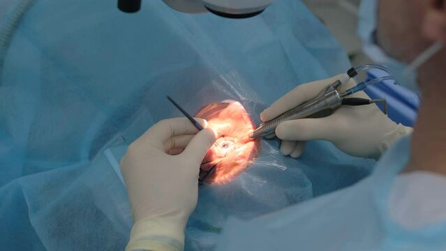 Ophthalmological surgery specialist sits in front of microscope performing operation. Low angle view on the female doctor conducting high-precision surgery. Femto Laser Assisted Cataract Surgery.