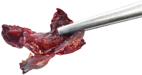 Thick blood tissue with forceps