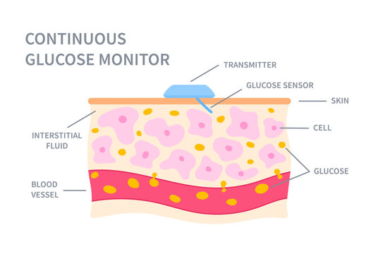 Continuous glucose sugar monitor. Glucometer wireless transmeter. CGM device on patient's skin. Measurement of blood glucose level. Vector illustration.