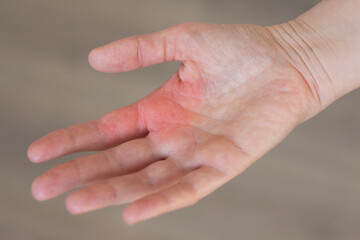 Dermatitis on skin. Human hand. Dermatological disease. The symptom is itching, pain, redness and rash. Allergic reaction. Medical diagnostics and treatment. Photo closeup