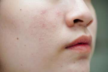 Acne pimple and scar on skin face, disorders of sebaceous glands, teenage girl skincare beauty...
