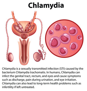 Chlamydia trachomatis with explanation