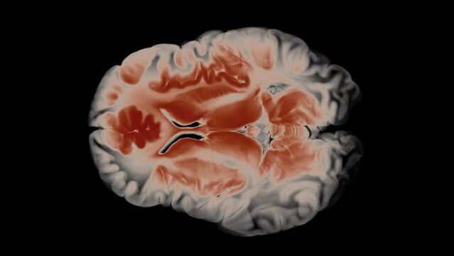 Top View Brain With Alpha Matte. Neurological Diseases, Tumors And Brain Surgery