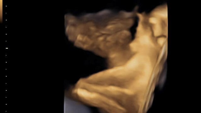  Ultrasound Scan Gestation 4d Sonography Pregnancy Fetus check