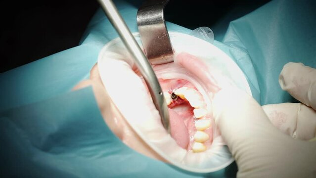 Medical darsonvalization procedure for a young woman