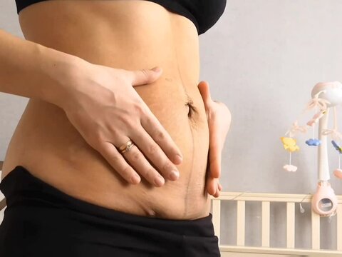 Scar on a woman belly from a caesarean section. Hands touching the skin. Deposition of the abdomen fat. Body after pregnancy. Stretch marks and overweight.	