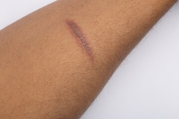 Minor Burn on Arm - Not Dangerous