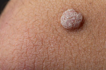 close up of skin, Zoomed-in Shot of Wart on Arm