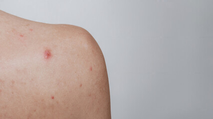 Close-up of the skin on the shoulder of a young girl with problems. Pimples, acne, pores, scars. Natural skin without filters. A place for your text.