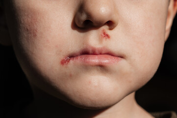 A boy with sores on his face. An ulcer covered with a crust under the nose and at the lip....