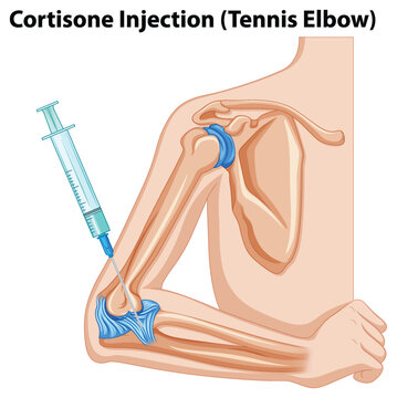 Cortisone Injection (Tennis Elbow) Diagram