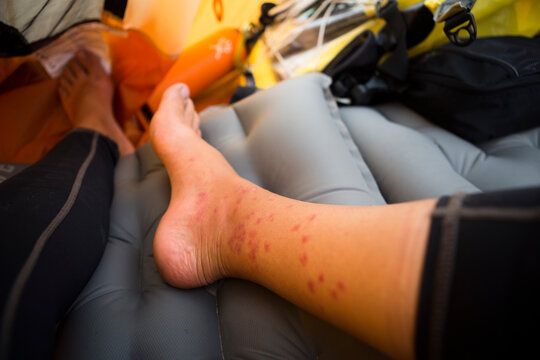 After Applying Steroid Cream, The Swelling Of Numerous Mosquito And Gnat Bites Are Reduced To Show The Individual Bites Marks Whilst Resting In Camp On The River Banks Of The Amur 