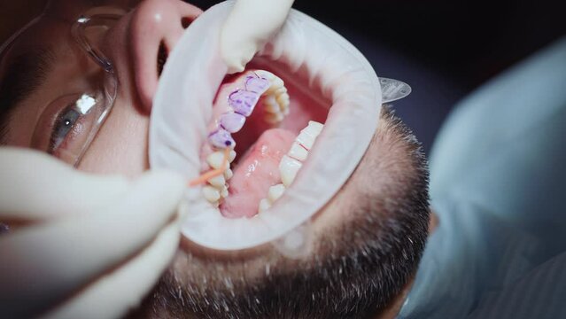 Hands of dentist cleans a man's teeth. Hydience and healthy in modern clinic. Healthcare. Protective glasses