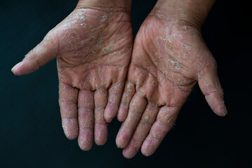 Fototapeta premium Chemical dermatitis and severe allergic reactions. There is peeling skin on the palms and feet.