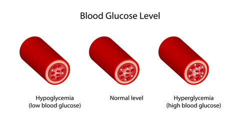 Blood Glucose Levels. Normal level, hypoglycemia (low blood sugar), hyperglycemia (high blood sugar), sugar test. vector diagram	
