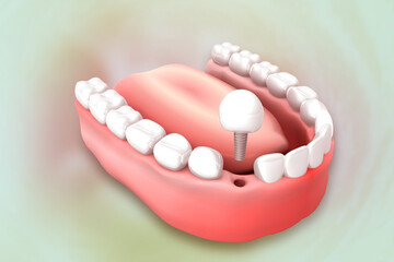 Fototapeta na wymiar Tooth implant, Healthy teeth and dental implant, 3d illustration