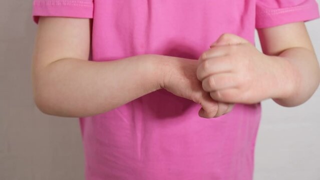 atopic dermatitis concept, a girl scratches the skin of her hands covered with a rash, redness of the skin, an allergy in a child 4K