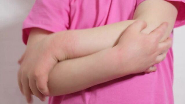 atopic dermatitis concept, a girl smears cream on the skin of her hands covered with a rash