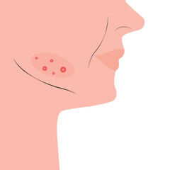 Skin health problems. Acne pimples on female face