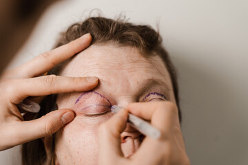Fototapeta premium Blepharoplasty markup close-up on the face before the plastic surgery operation for modifying the eye region of the face in medical clinic.