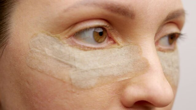 Plastic surgery blepharoplasty. Close-up of a girl's eyes in a medical bandage after plastic surgery blepharoplasty of the lower eyelids. Removal of fat bags or fat hernias under the eyes.