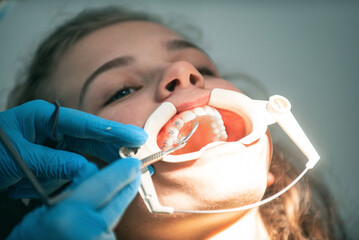 Dentist appointment at a dental clinic, placing braces locks on the teeth and pulling the archwire...