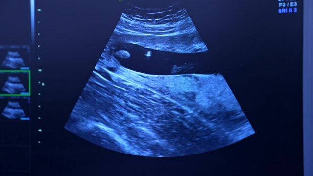 Ultrasonic image of female reproductive organs. Diagnostics of a patient before the extracorporeal insemination. Close up.