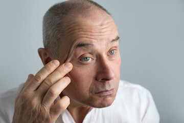 Obraz premium close-up of face of bald mature man 60 years old looks in mirror, critically examines face, skin, wrinkles, upset because age-related changes, midlife crisis, hair loss, selective focus