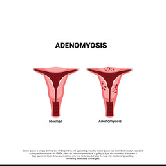 Adenomyosis. Comparison normal and unhealthy abnormal women uterus. female reproductive system. medical condition when cells endometrium atypically located among the cells of the cells of the uterine