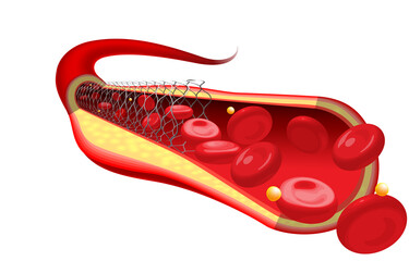 Medical and educational illustrations of the stent are already inserted, improving blood flow.