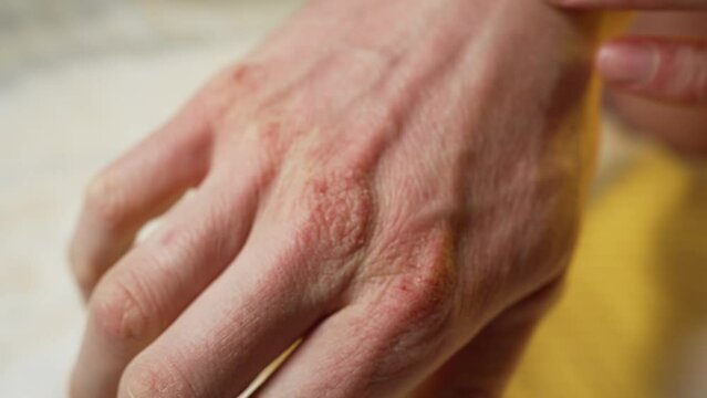 Male hand with dry cracked skin close up