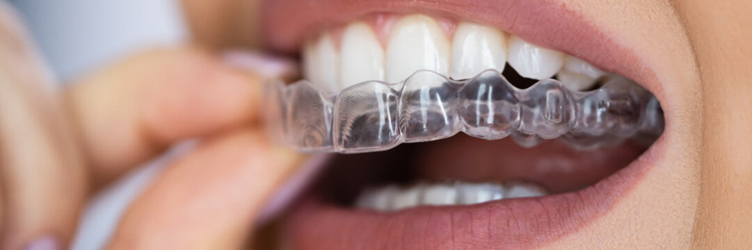 Clear Aligner Dental Night Guard