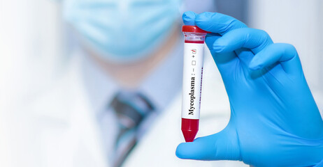Doctor holding a test blood sample tube positive with Mycoplasma test on the background of medical test tubes with analyzes.
