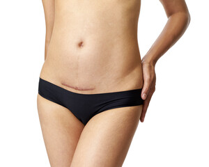 Closeup of woman belly with a scar from a cesarean section with her hands on white background - obrazy, fototapety, plakaty