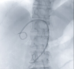 X-ray image of catheter in Upper abdomen.