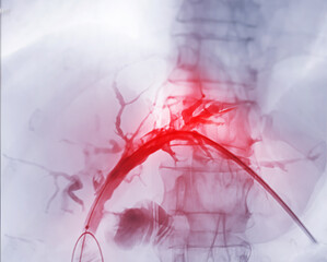 X-ray image of  portal vein  after Doctor doing ERCP and laparoscopic cholecystectomy inside modern...