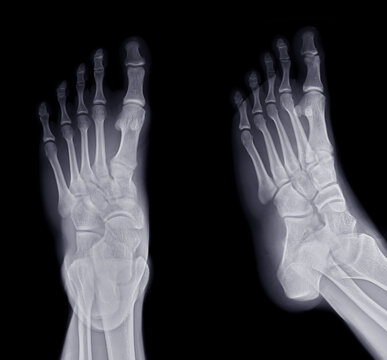 Foot x-ray image AP and Oblique  view  isolated on black background.