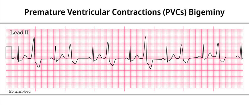 Bigeminy Premature Ventricular Contractions (PVCs) - Ventricular Premature Beat - VES - 8 Second ECG Paper - Electrocardiography Vector Medical Illustration