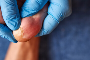 Fototapeta na wymiar The doctor examines the damaged skin of the toe. Dermatological skin diseases.