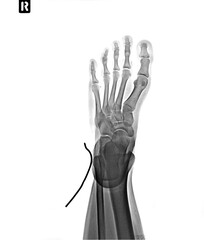 X-ray of the foot with a stinger
