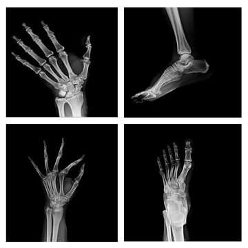 Collection of x-ray . x-ray foot and hand .