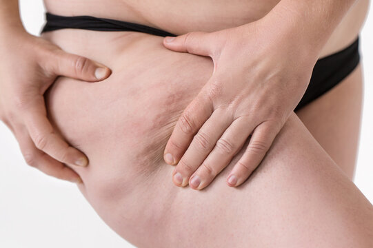 Female hands squeezing her thigh to show cellulite closeup. Woman shows holding and pushing skin of hips cellulite, orange peel. Treatment and disposal of excess weight, deposition of subcutaneous fat