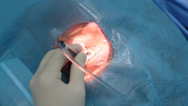 Ophthalmological surgery specialist sits in front of microscope performing operation. Low angle view on the female doctor conducting high-precision surgery. Femto Laser Assisted Cataract Surgery.