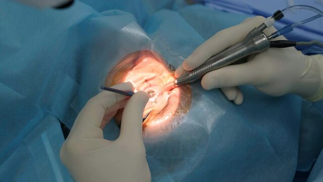 Ophthalmological surgery specialist sits in front of microscope performing operation. Low angle view on the female doctor conducting high-precision surgery. Femto Laser Assisted Cataract Surgery.