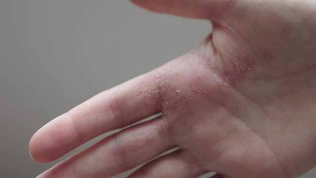 atopic dermatitis on hands dry itchy inflamed skin flare irritations on palm of hand. dry cracks on fingers inside, painful disease. red, dry patches skin female hand. neurodermatitis symptoms