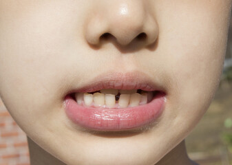 Naklejka premium A child's face showing teeth