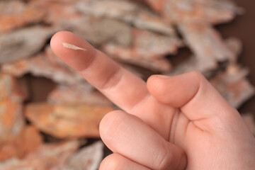 Woman with splinter in her finger on blurred background, closeup