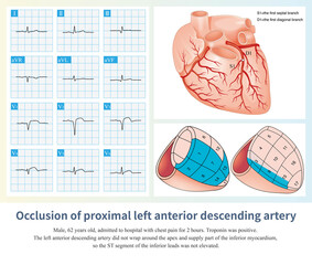 After the first diagonal branch and before the first septal branch of the LAD were occluded, the infarction affected the anterior septum, and the high lateral wall was not affected.