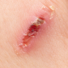 Wound on human skin. Macro